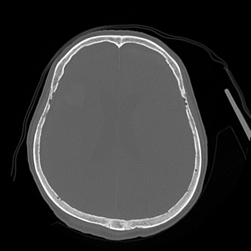 Cerebral contusions, subarachnoid hemorrhage and subdural hygromas (Radiopaedia 55399-61827 Axial bone window 32).png