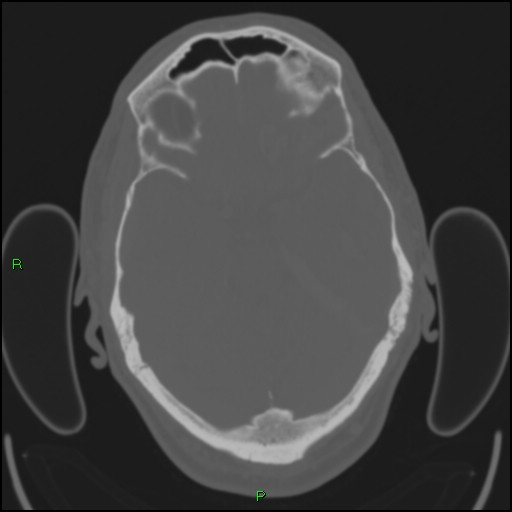 Cerebral contusions (Radiopaedia 33868-35039 Axial bone window 69).jpg