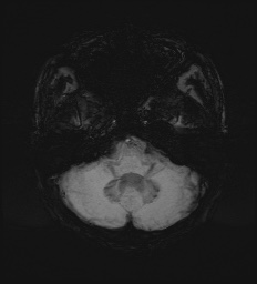 Cerebral embolic infarcts (embolic shower) (Radiopaedia 72391-82921 Axial SWI 16).jpg