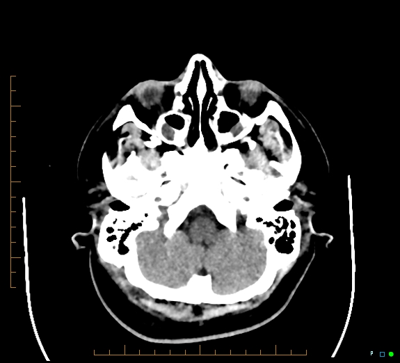 File:Cerebral fat embolism (Radiopaedia 85521-101220 Axial non-contrast 16).jpg