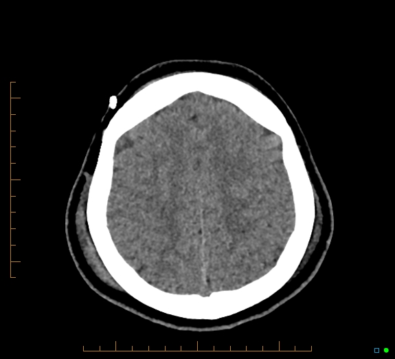 Cerebral fat embolism (Radiopaedia 85521-101224 Axial non-contrast 40).jpg