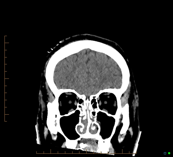 Cerebral fat embolism (Radiopaedia 85521-101224 Coronal non-contrast 15).jpg