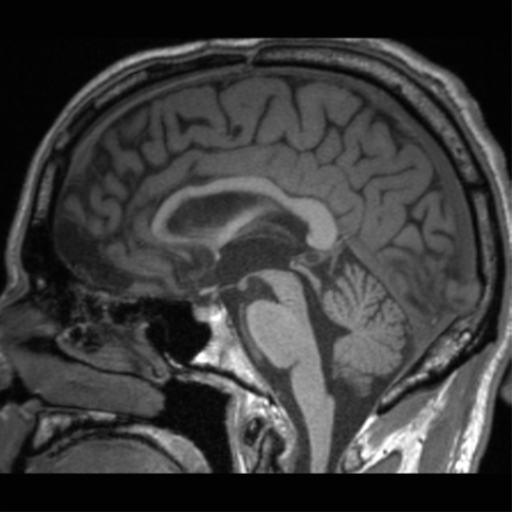 Cerebral hemorrhagic contusions- temporal evolution (Radiopaedia 40224-42757 Axial T1 79).png
