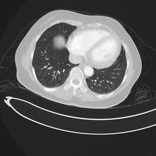File:Cerebral metastases (Radiopaedia 33041-34055 Axial lung window 39).png