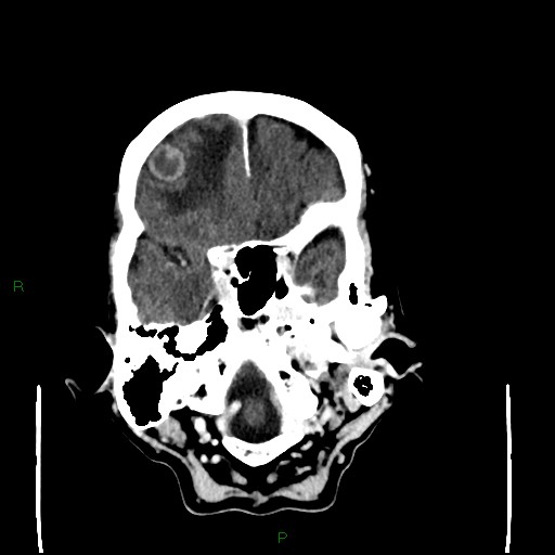 File:Cerebral metastases - breast primary (Radiopaedia 77653-89857 Axial C+ delayed 26).jpg