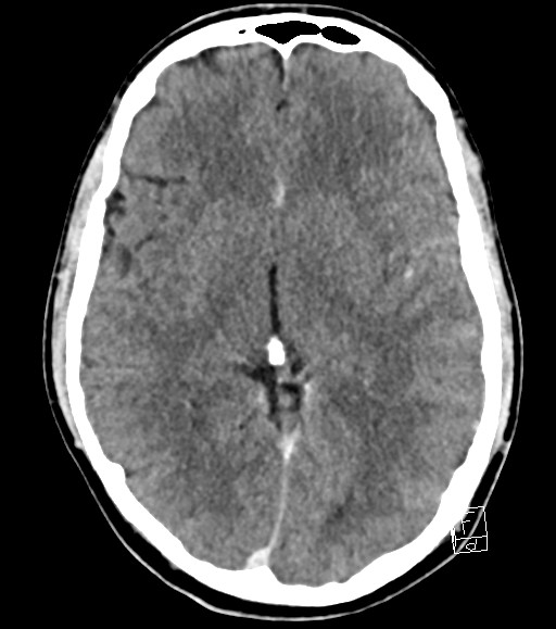 Cerebral metastases - testicular choriocarcinoma (Radiopaedia 84486-99855 Axial C+ delayed 31).jpg