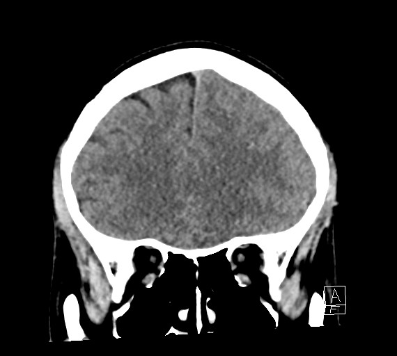 Cerebral metastases - testicular choriocarcinoma (Radiopaedia 84486-99855 Coronal C+ delayed 19).jpg