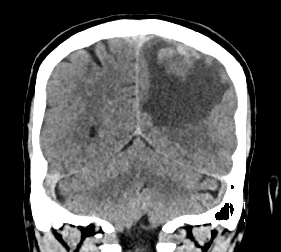 Cerebral metastases - testicular choriocarcinoma (Radiopaedia 84486-99855 Coronal C+ delayed 46).jpg