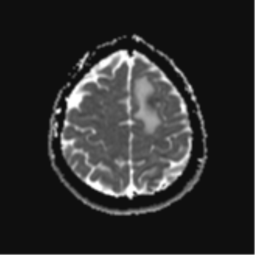 File:Cerebral metastases mimicking abscesses (Radiopaedia 45841-50131 Axial ADC 23).png