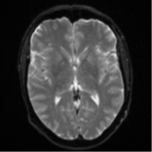 Cerebral metastasis - colorectal adenocarcinoma (Radiopaedia 50394-55765 Axial DWI 13).png