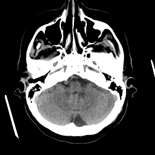 Cerebral metastasis to basal ganglia (Radiopaedia 81568-95412 Axial non-contrast 18).png