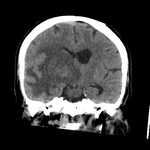 Cerebral metastasis to basal ganglia (Radiopaedia 81568-95412 Coronal non-contrast 36).png