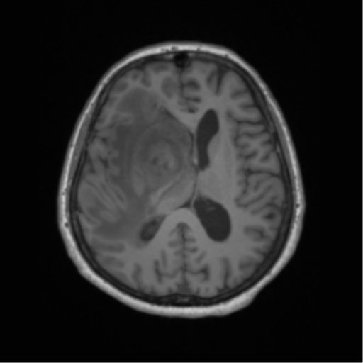 Cerebral metastasis to basal ganglia (Radiopaedia 81568-95413 Axial T1 41).png