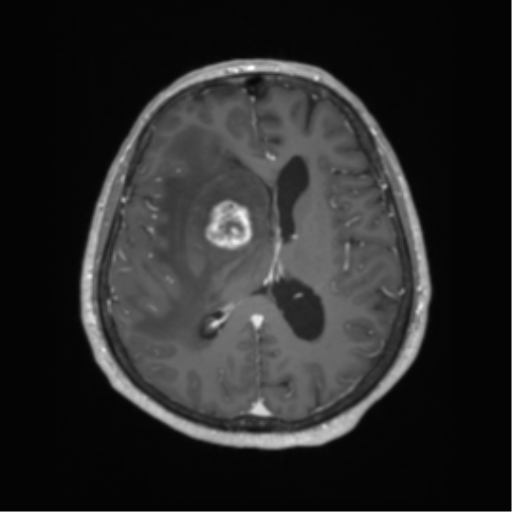Cerebral metastasis to basal ganglia (Radiopaedia 81568-95413 Axial T1 C+ 42).png