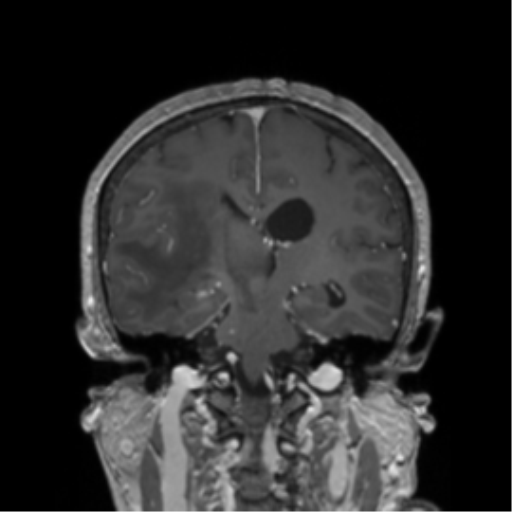 File:Cerebral metastasis to basal ganglia (Radiopaedia 81568-95413 Coronal T1 C+ 20).png