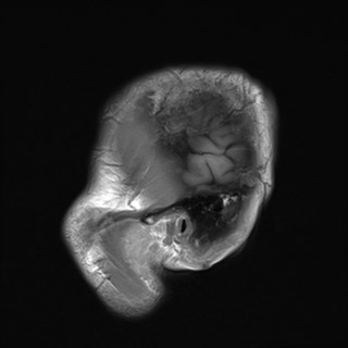 File:Cerebral toxoplasmosis (Radiopaedia 43956-47461 Sagittal T1 1).jpg