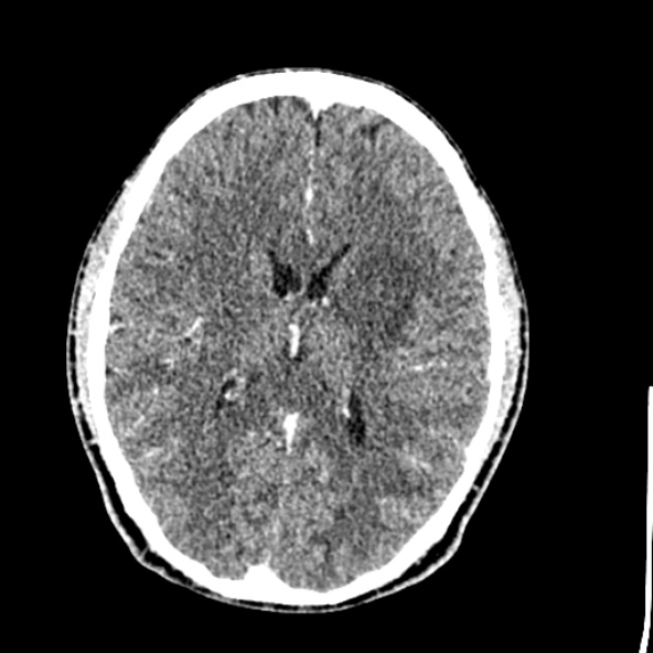 Cerebral toxoplasmosis (Radiopaedia 53993-60131 Axial C+ delayed 42).jpg