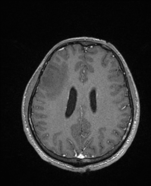 Cerebral toxoplasmosis (Radiopaedia 85779-101597 Axial T1 C+ 109).jpg