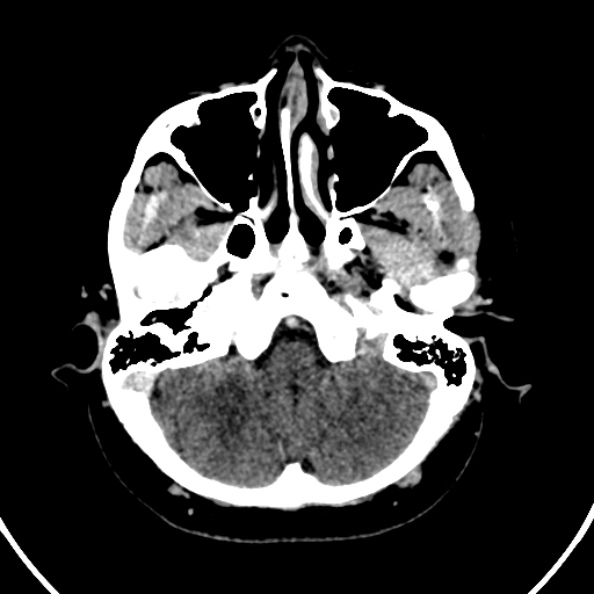 Cerebral venous hemorrhagic infarct from venous sinus thrombosis (Radiopaedia 55433-61883 Axial C+ delayed 123).jpg