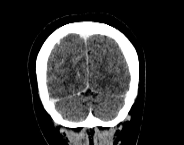 Cerebral venous hemorrhagic infarct from venous sinus thrombosis (Radiopaedia 55433-61883 Coronal C+ delayed 52).jpg