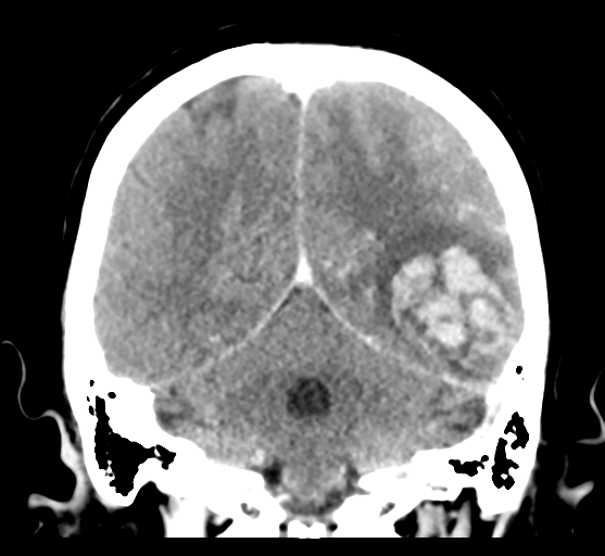 Cerebral venous hemorrhagic infarction (Radiopaedia 57576-64538 Coronal C+ 42).png