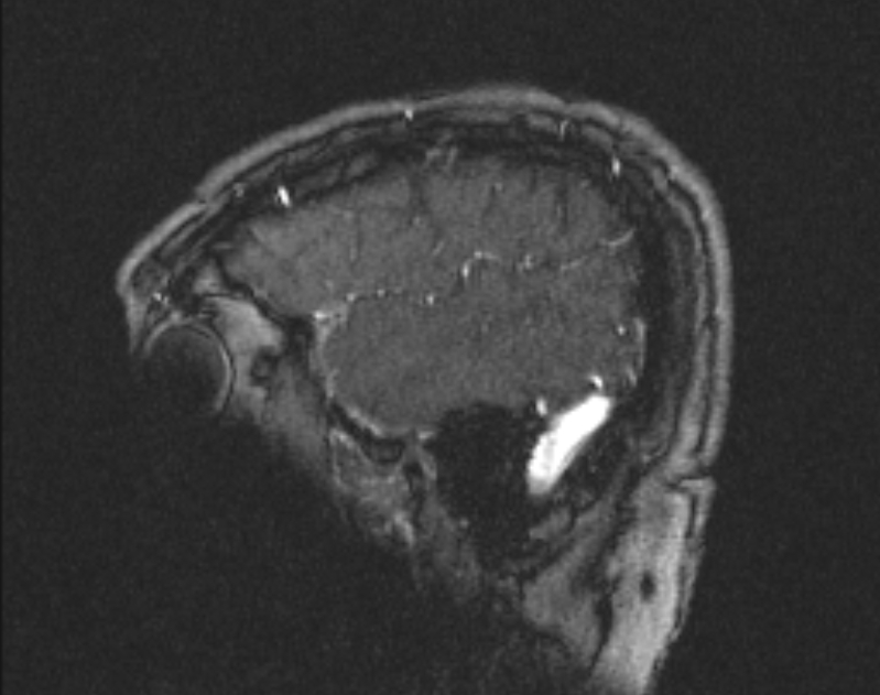 Cerebral venous infarction (Radiopaedia 65166-74176 Sagittal TOF 62).jpg