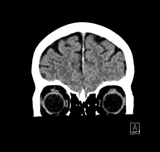 Cerebral venous infarction with hemorrhage (Radiopaedia 65343-74381 Coronal non-contrast 7).jpg