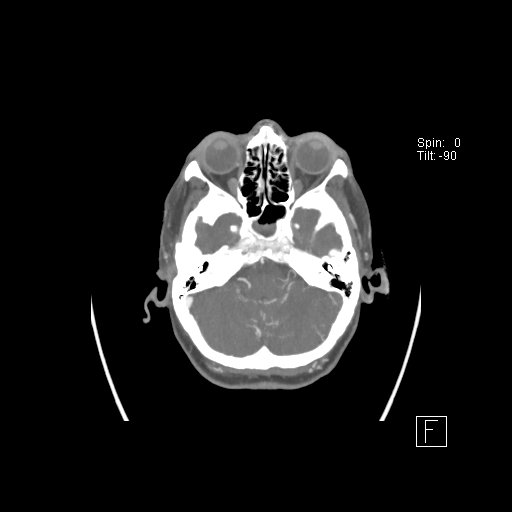 Cerebral venous infarction with hemorrhage (Radiopaedia 65343-74396 A 21).jpg