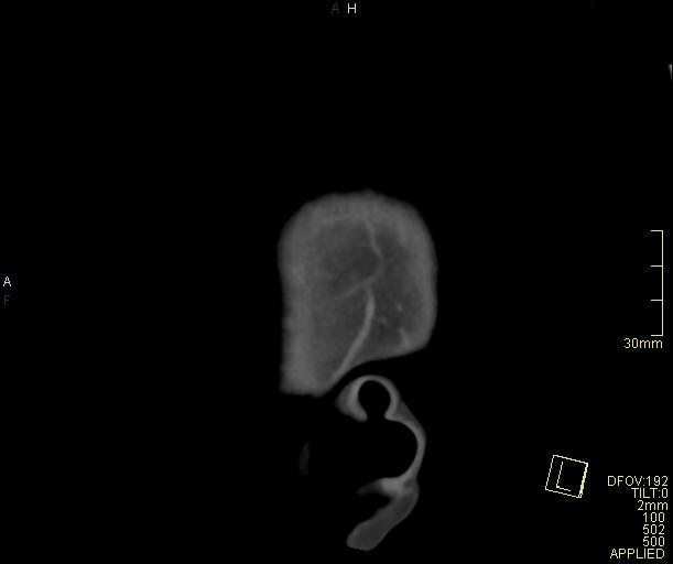 Cerebral venous sinus thrombosis (Radiopaedia 91329-108965 Sagittal venogram 2).jpg