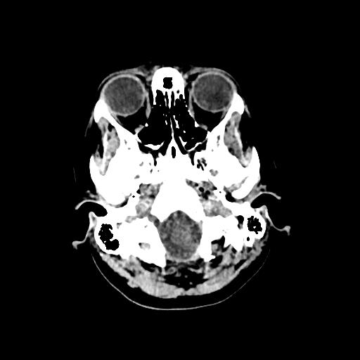 Cerebral venous throbmosis - hemorrhagic venous infarction (Radiopaedia 87318-103613 Axial non-contrast 19).jpg