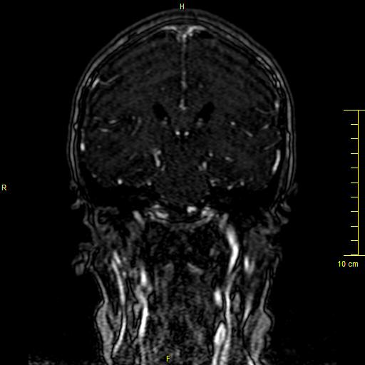 Cerebral venous thrombosis (Radiopaedia 23288-23351 MRV 89).JPG