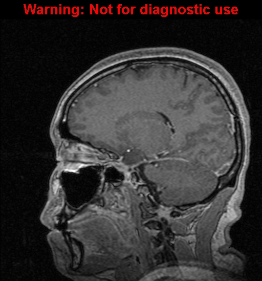 Cerebral venous thrombosis (Radiopaedia 37224-39208 Sagittal T1 C+ 92).jpg