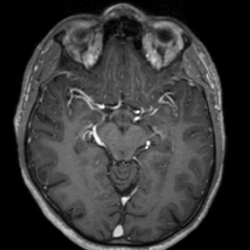 Cerebral venous thrombosis (Radiopaedia 38392-40469 Axial T1 C+ 35).png