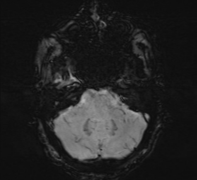 Cerebral venous thrombosis (Radiopaedia 71207-81504 Axial SWI 9).jpg