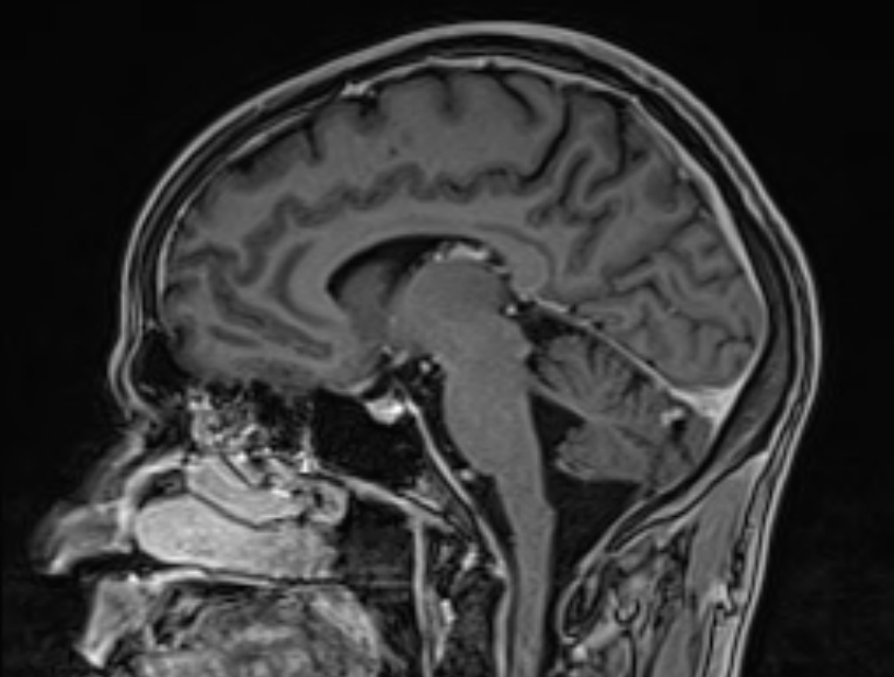 Cerebral venous thrombosis (Radiopaedia 71207-81504 Sagittal T1 C+ 28).jpg