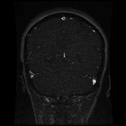 Cerebral venous thrombosis - ulcerative colitis (Radiopaedia 66049-75219 Coronal MRV 37).jpg