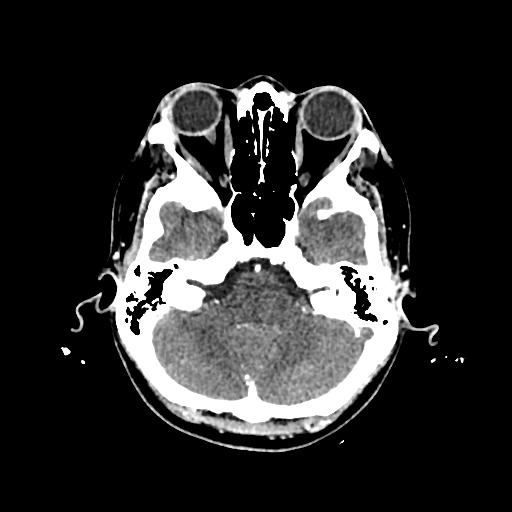 File:Cerebral venous thrombosis with venous hemorrhagic infarct (Radiopaedia 90354-107660 Axial with contrast 42).jpg