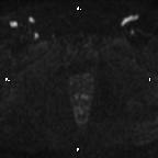 File:Cervical adenocarcinoma (Radiopaedia 65011-73985 Axial DWI 17).jpg