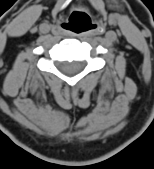 File:Cervical canal stenosis - OPLL and osteophytes (Radiopaedia 47329-51910 Axial non-contrast 31).png