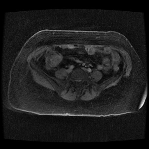 Cervical carcinoma (Radiopaedia 70924-81132 Axial T1 C+ fat sat 260).jpg