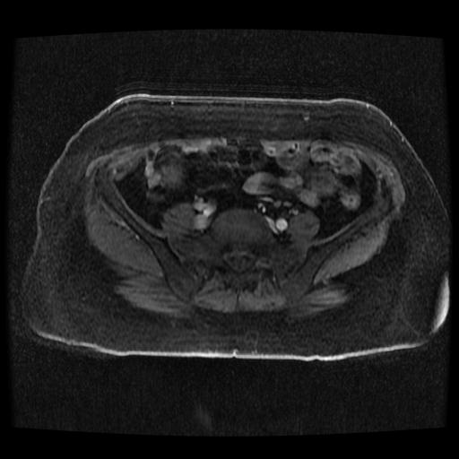 File:Cervical carcinoma (Radiopaedia 70924-81132 Axial T1 C+ fat sat 77).jpg