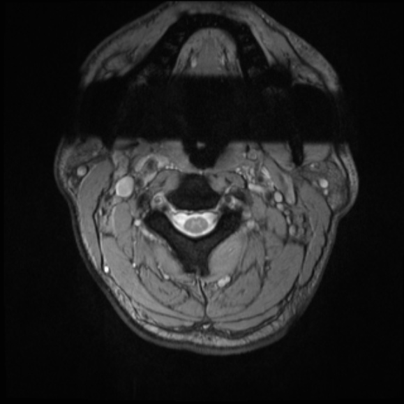 File:Cervical disc extrusion (Radiopaedia 53950-60077 Axial T2 4).jpg