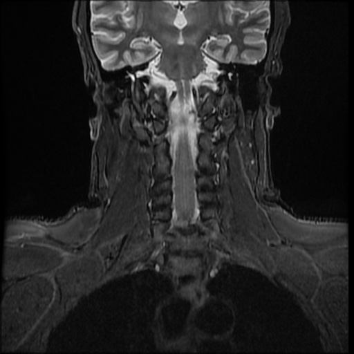 File:Cervical disc extrusion (Radiopaedia 59074-66364 Coronal STIR 6).jpg