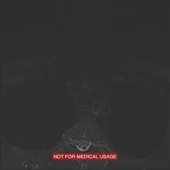 File:Cervical nerve schwannoma (Radiopaedia 27964-28221 C 52).jpg