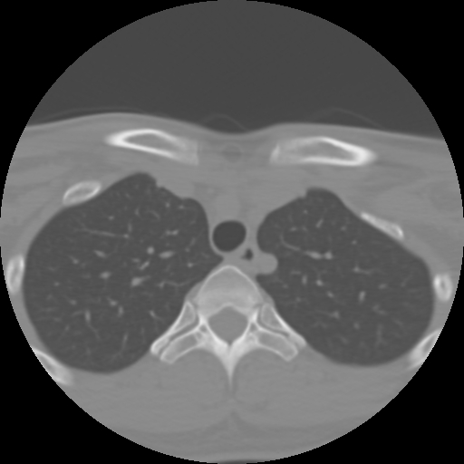 Cervical rib (Radiopaedia 71110-81363 Axial non-contrast 58).jpg