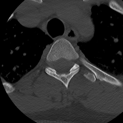 File:Cervical schwannoma (Radiopaedia 57979-64974 Axial bone window 53).png