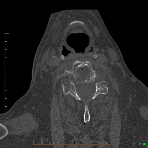Cervical spine fracture - ankylosing spondylitis (Radiopaedia 76835-88706 Axial bone window 139).jpg
