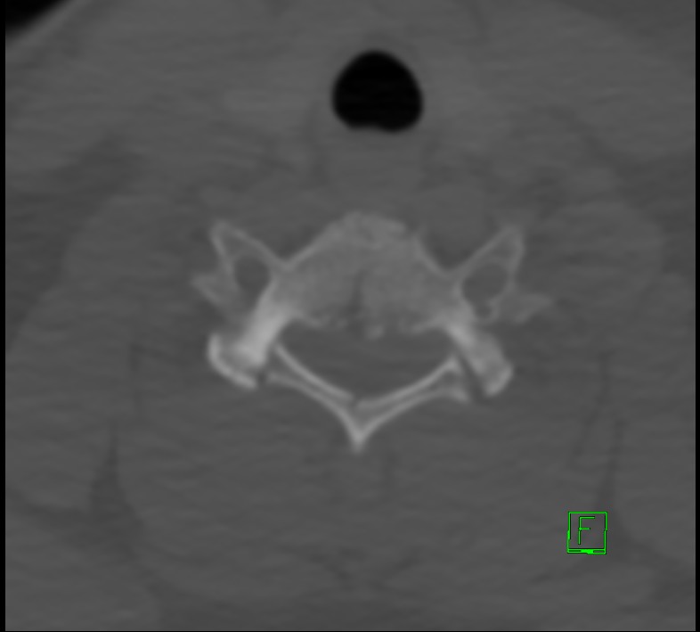 Cervical spine fracture - hyperflexion injury (Radiopaedia 66184-75364 Axial bone window 39).jpg