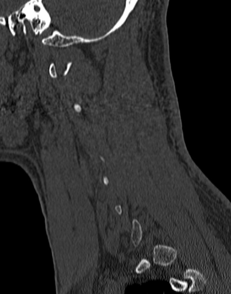 Cervical spondylodiscitis (Radiopaedia 28057-29489 Sagittal bone window 50).jpg