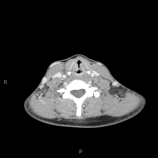 File:Cervical thymic cyst (Radiopaedia 88632-105335 C 48).jpg